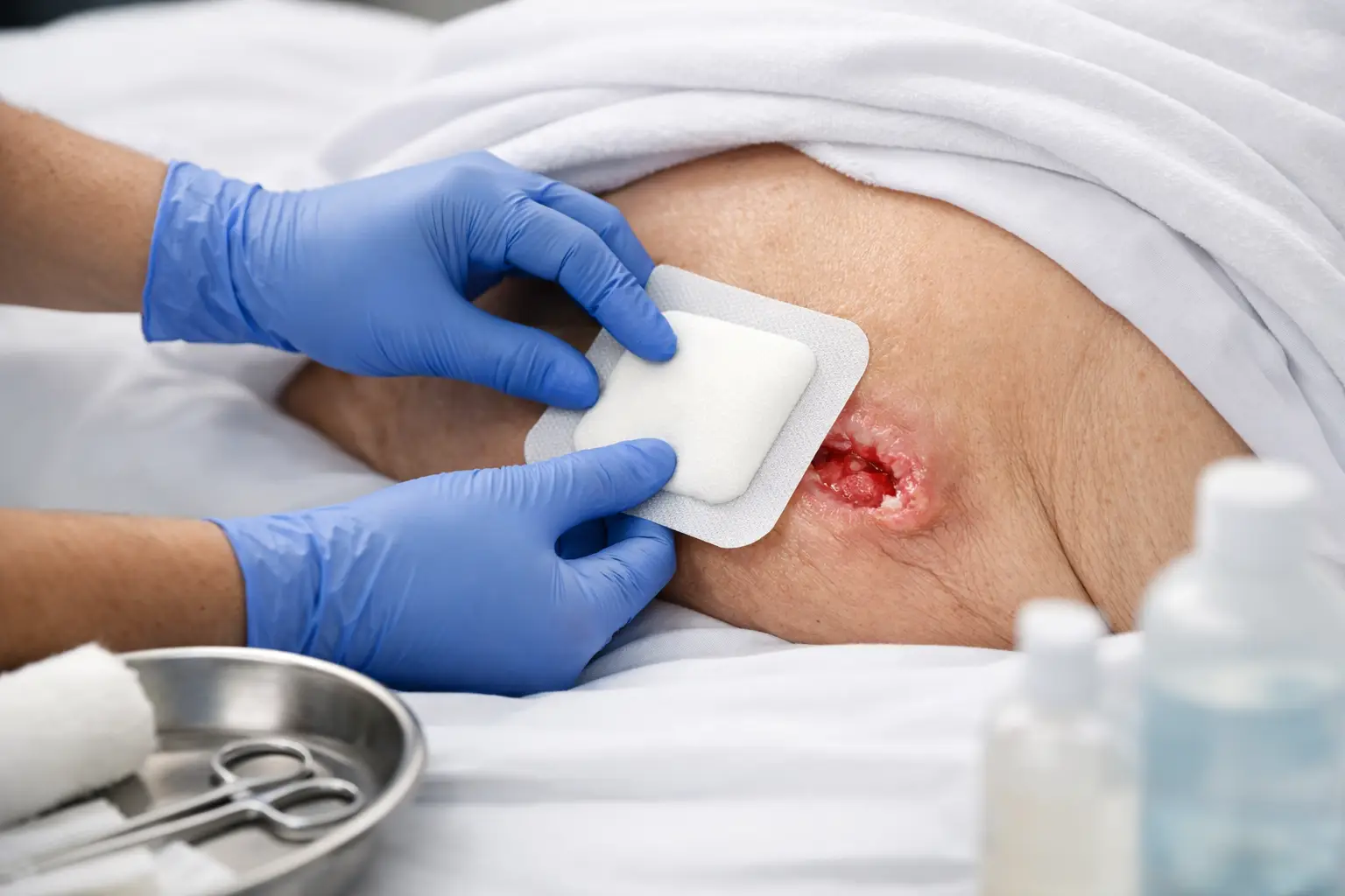 Curativo certo na lesão por pressão 2